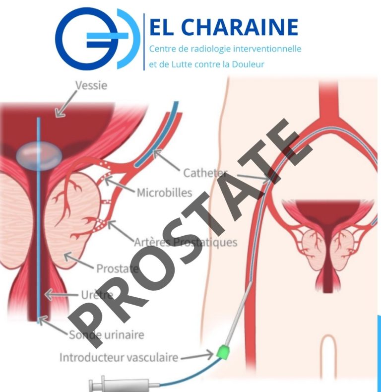 EMBOLISATION d’ADENOME de PROSTATE